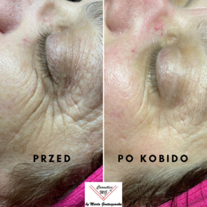 Efekty masażu Kobido, likwidacja zmarszczek pod oczami, masaż Kobido w Tarnowie i Krakowie